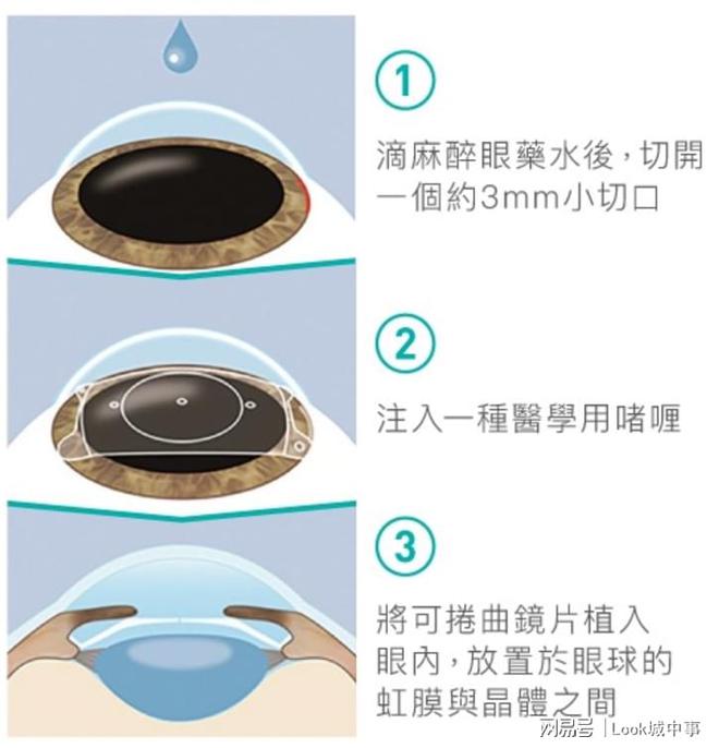 解除眼镜束缚 ICL“植入式隐形眼镜”成香港矫视新趋势(图1)