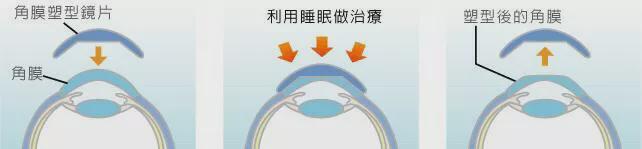 看完近视价格表我彻底瞎了(图6)