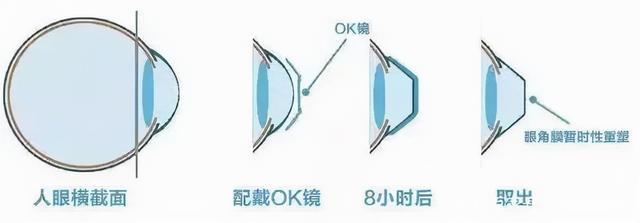 花8000买来的“OK”镜成本却只要110元又一个暴利行业被熟知(图8)