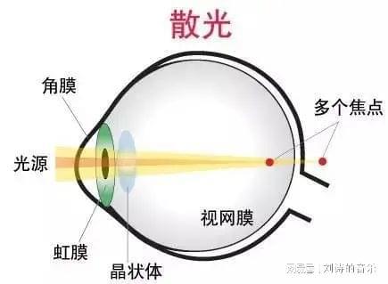 眼睛为什么会有散光？散光可以矫正吗？im电竞平台(图2)