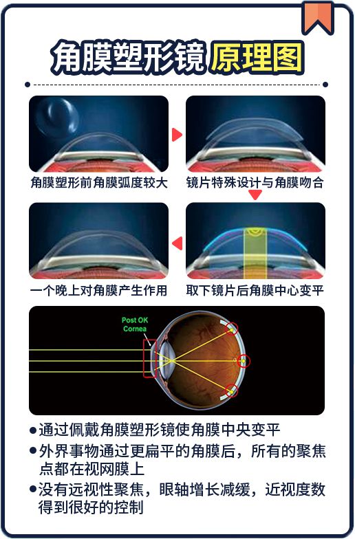 正确佩戴角膜塑形镜有效控制近视发展(图1)