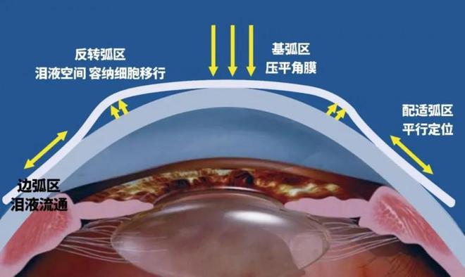 五一趣拿礼！厦门眼科中心OK镜优惠至高2200元(图3)